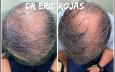 Tiene pérdida de cabello ?