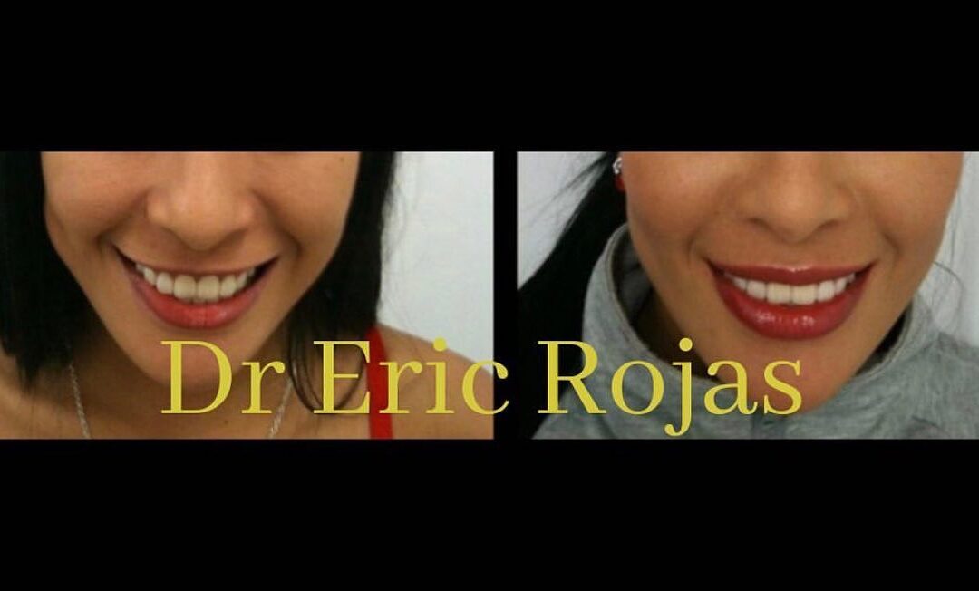 Remodelación labial