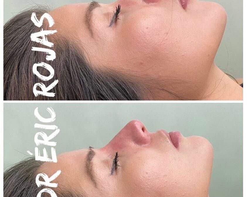 Rino lift Nariz perfecta