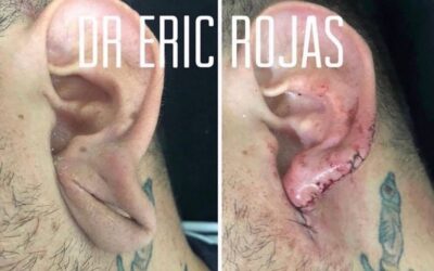 Reconstrucción de oreja