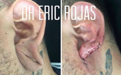 Reconstrucción de oreja