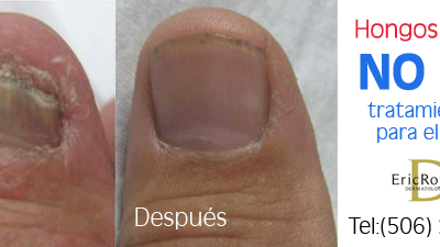 ¿Hongos en las uñas?