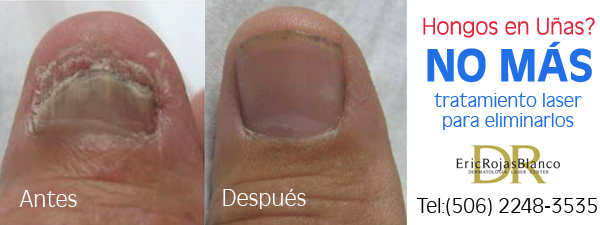 ¿Hongos en las uñas?