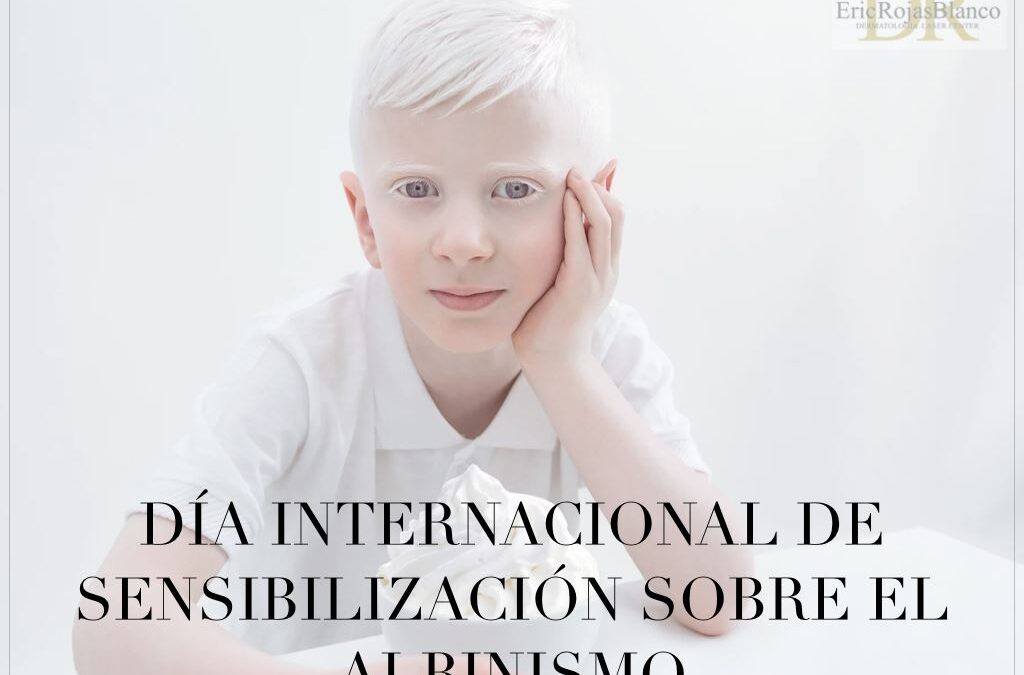 El albinismo
