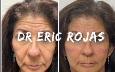 Rejuvenecimiento FACIAL