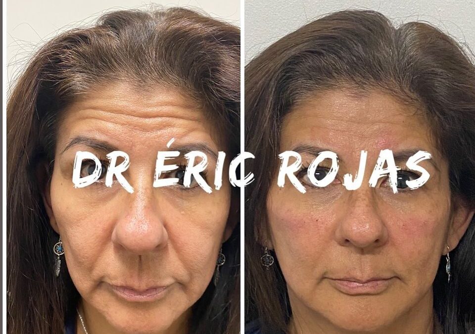 Rejuvenecimiento FACIAL