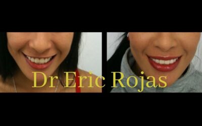 REMODELACIÓN LABIAL