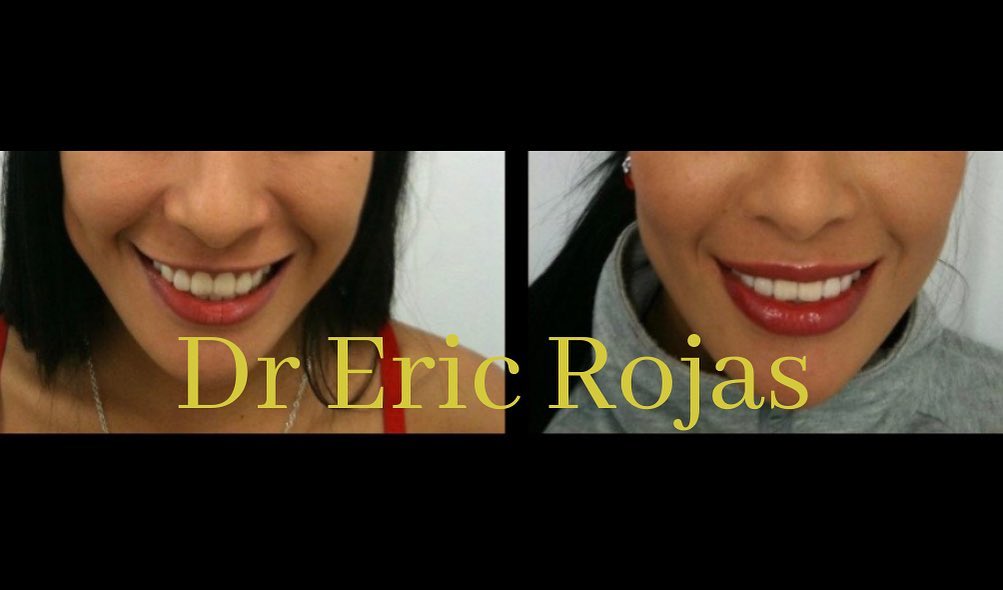 REMODELACIÓN LABIAL