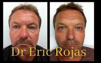 REJUVENECIMIENTO FACIAL