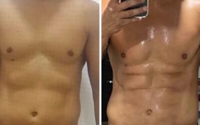 Slim laser en hombres
