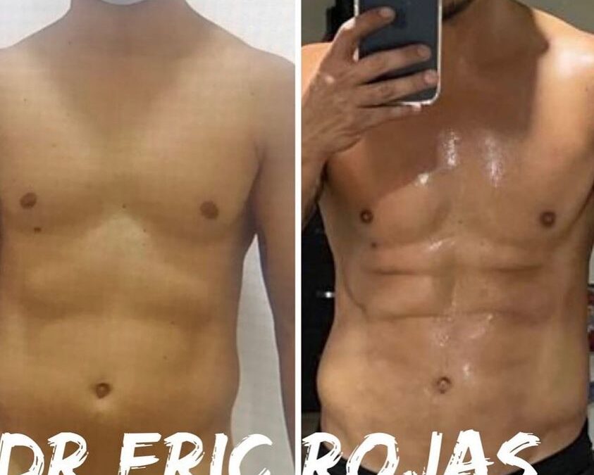 Slim laser en hombres