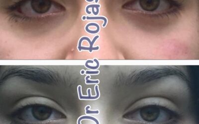 Ojeras fuera de tu cara