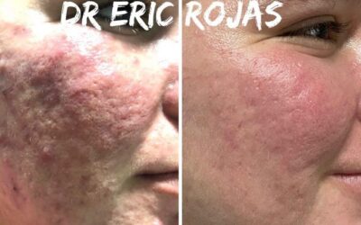 Rosacea ya no más el Dr Eric Rojas puede ayudarte a solucionar