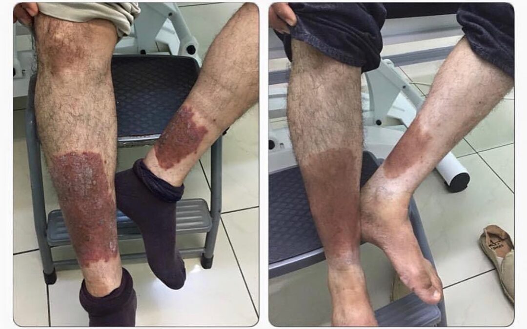 Tratamiento de un mes por psoriasis!