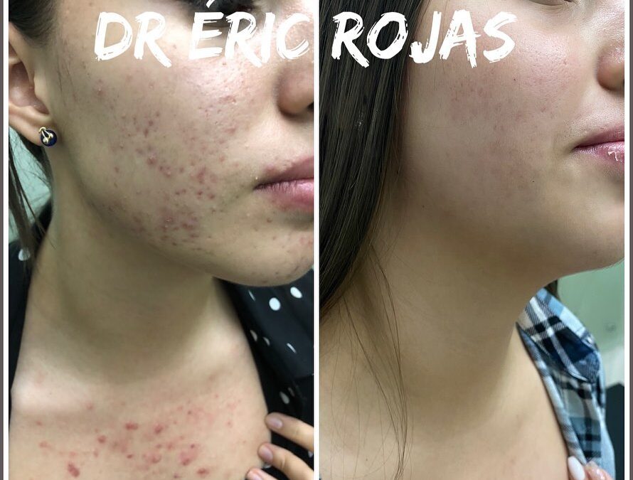 Rostros SIN ACNÉ DR ÉRIC ROJAS