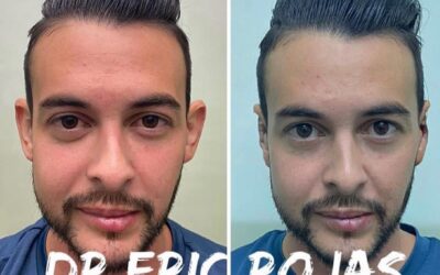 Corrección de orejas