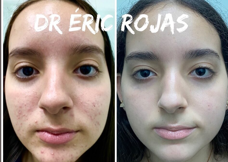 Rostros LIBRES DE ACNÉ DR ÉRIC ROJAS 22483535