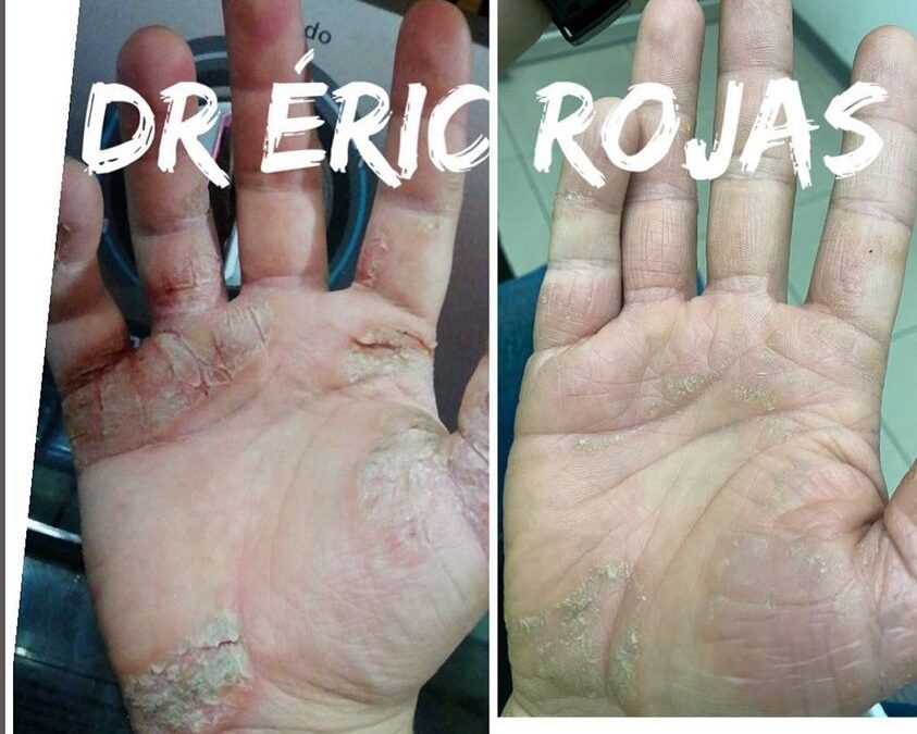 Podemos ayudarte con tus problemas de piel el Dr Eric Rojas te ayuda a mejorar