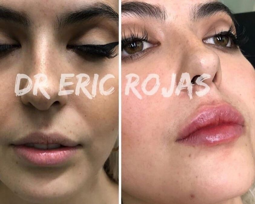 Relleno de labios