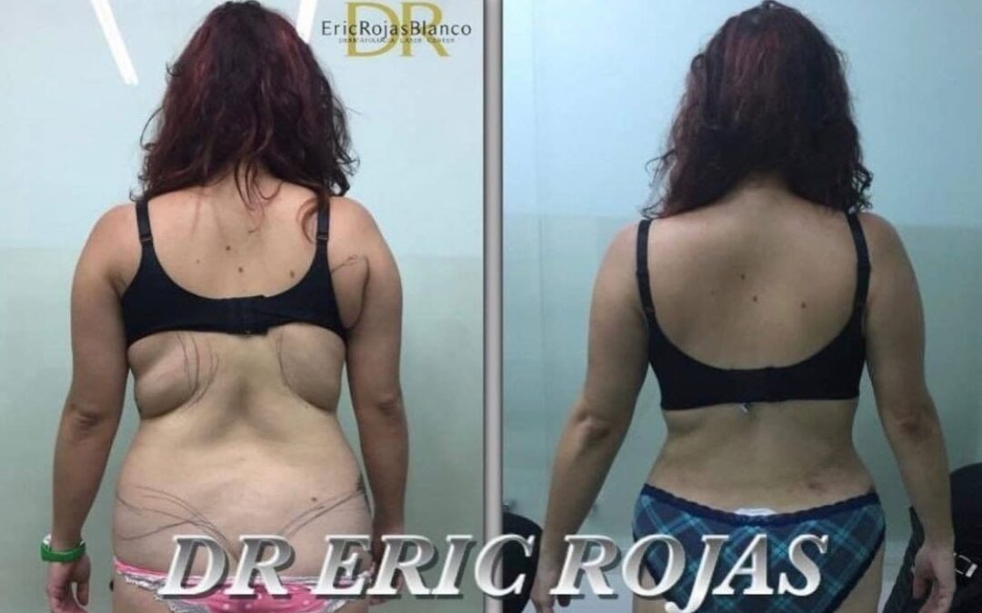 Slim laser en espalda
