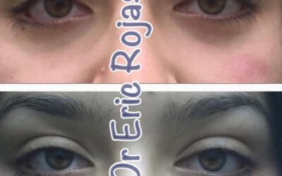 Ojeras ya no más