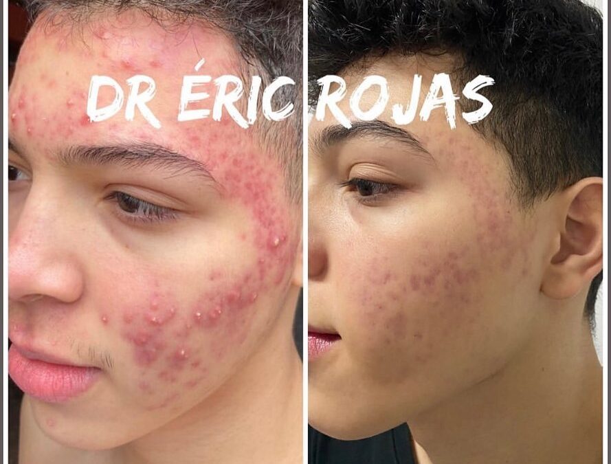 Tenemos un centro especializado de tratamiento del acné, y dejamos rostros libres de acné!