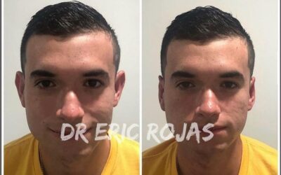 Corrección de orejas