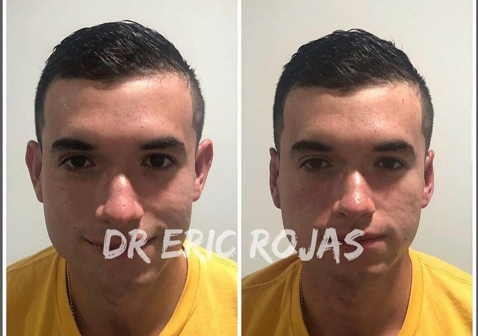 Corrección de orejas