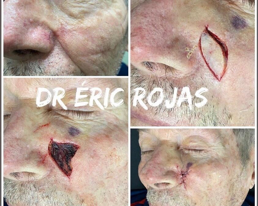 LESIONES MALIGNAS DE PIEL