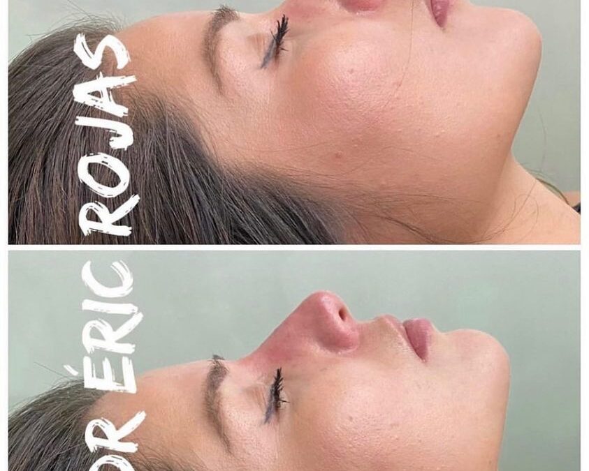 Corrección de nariz