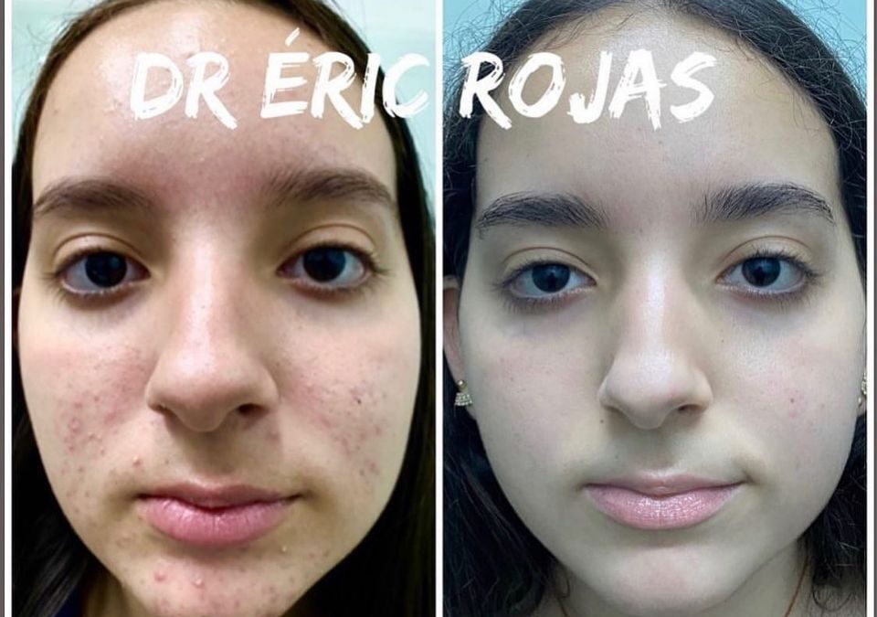 Rostros libres de acné