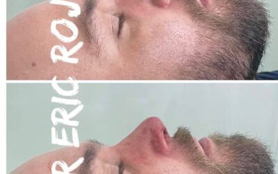 NARIZ PERFILADA SIN CIRUGÍA DR ÉRIC ROJAS 22483535
