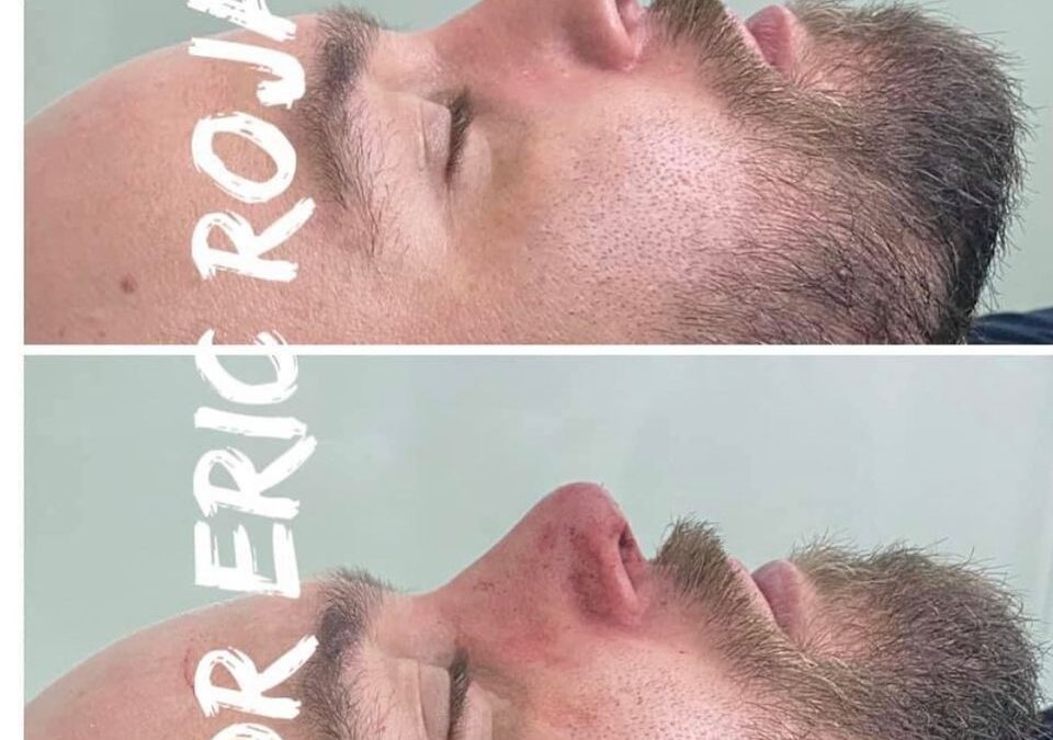 NARIZ PERFILADA SIN CIRUGÍA DR ÉRIC ROJAS 22483535
