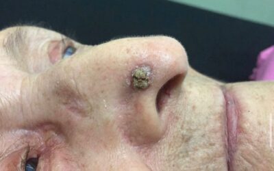 Carcinoma de piel