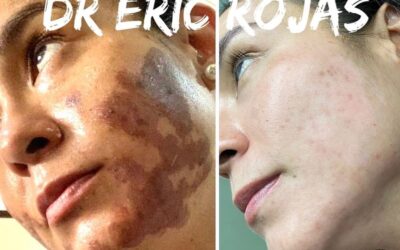 Paciente quemada con ácido en una estética NO SE LA JUEGUE BUSQUE SU DERMATOLOGO DR ÉRIC ROJAS 22483535