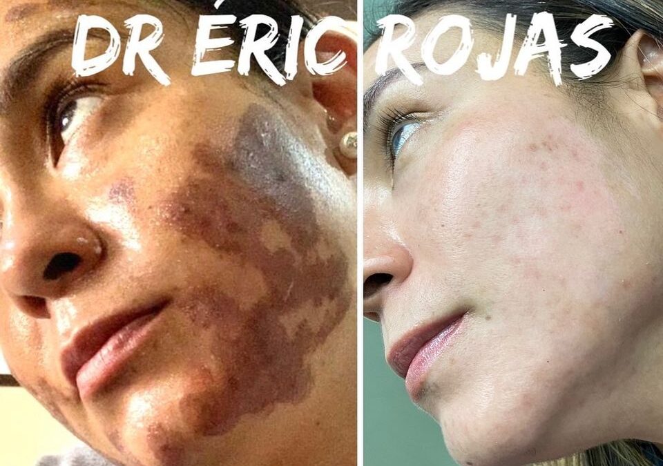 Paciente quemada con ácido en una estética NO SE LA JUEGUE BUSQUE SU DERMATOLOGO DR ÉRIC ROJAS 22483535