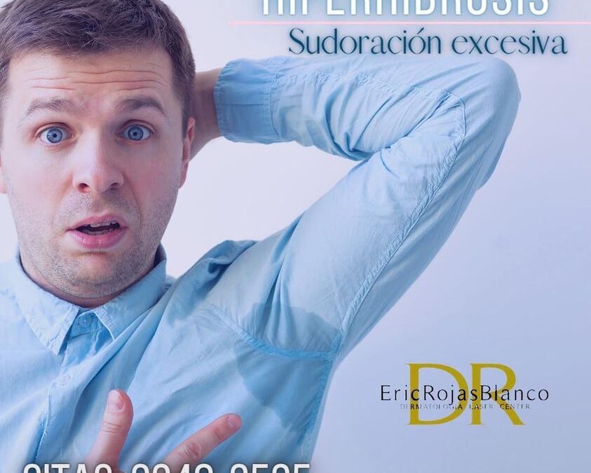 Podemos ayudarte con la sudoración excesiva!!