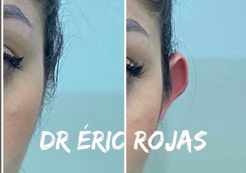 Corrección de orejas