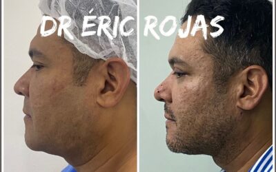 PAPADA SLIM LÁSER ELIMÍNALA DR ÉRIC ROJAS 22483535