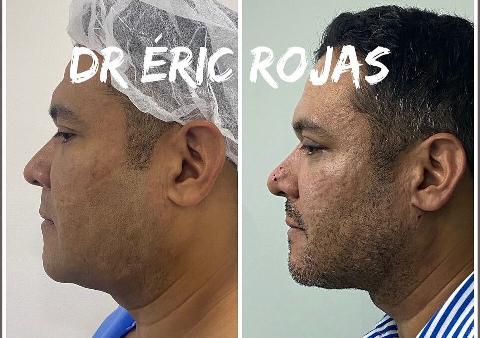 PAPADA SLIM LÁSER ELIMÍNALA DR ÉRIC ROJAS 22483535