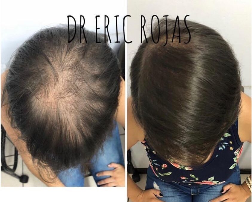 Si tienes pérdida de cabello