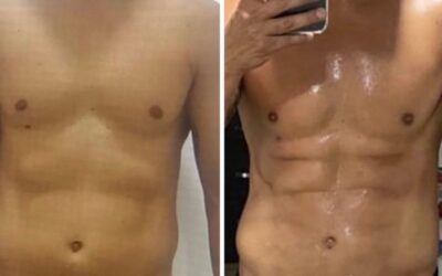 Slim laser en hombres
