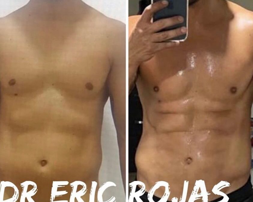 Slim laser en hombres