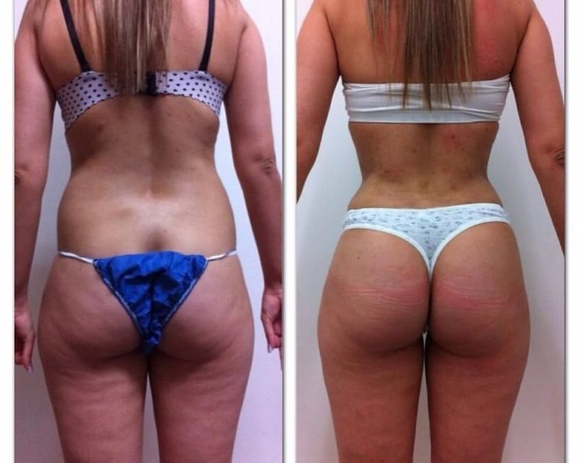 Ya no más celulitis