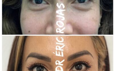 Dermo blefaroplastia