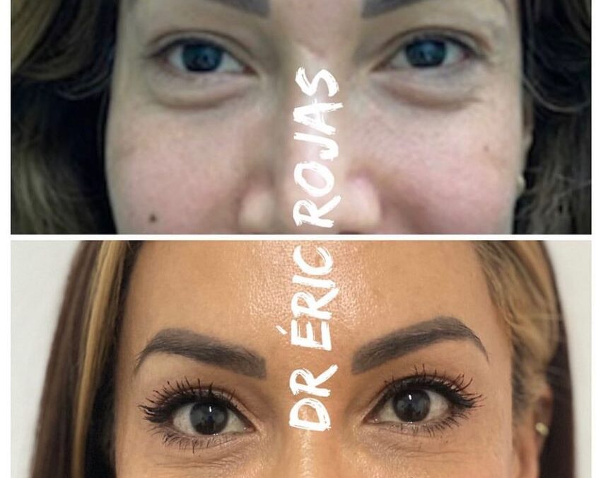 Dermo blefaroplastia