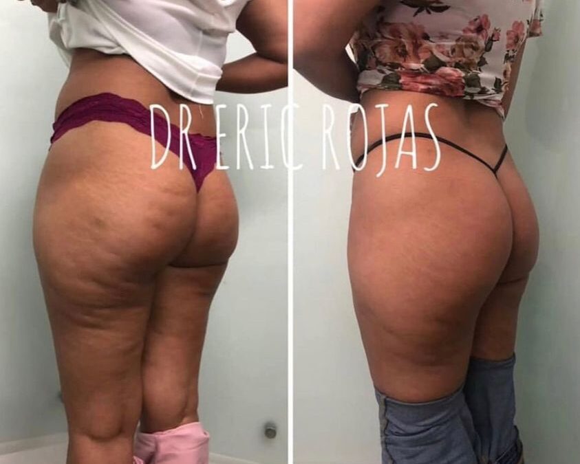 Celulitis ya no más