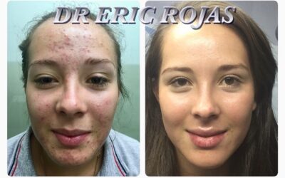 ACNE YA NO MÁS DR ÉRIC ROJAS 22483535
