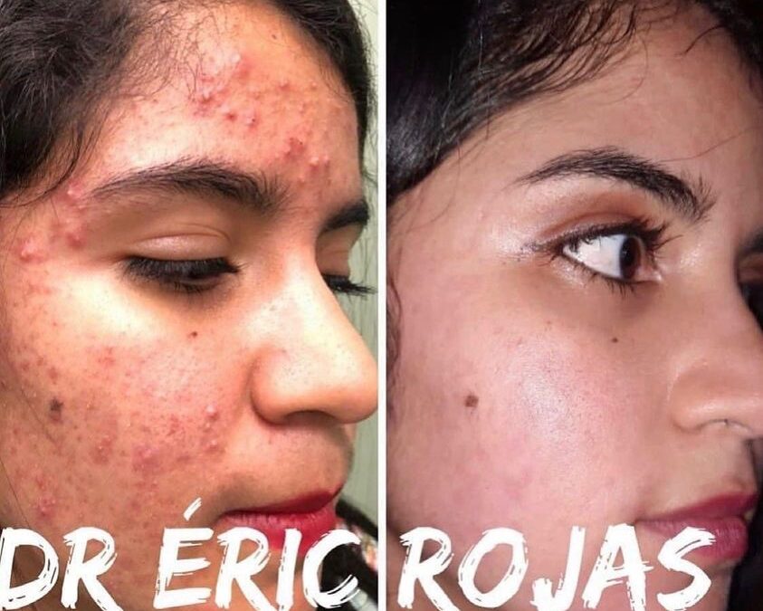 Eliminación de acné