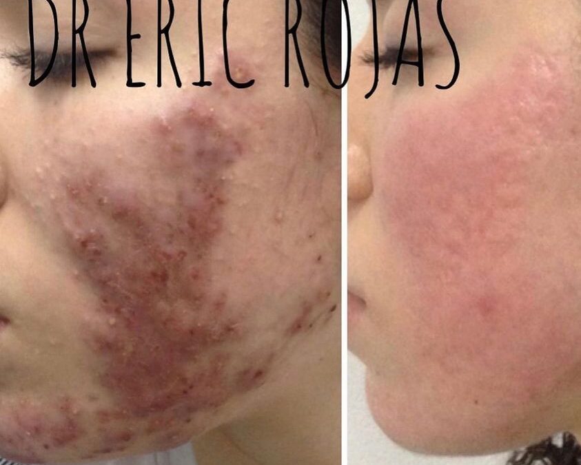 Eliminación de acné